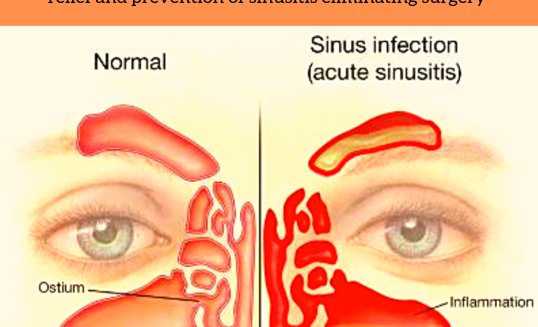 Homeopathy for Sinusitis